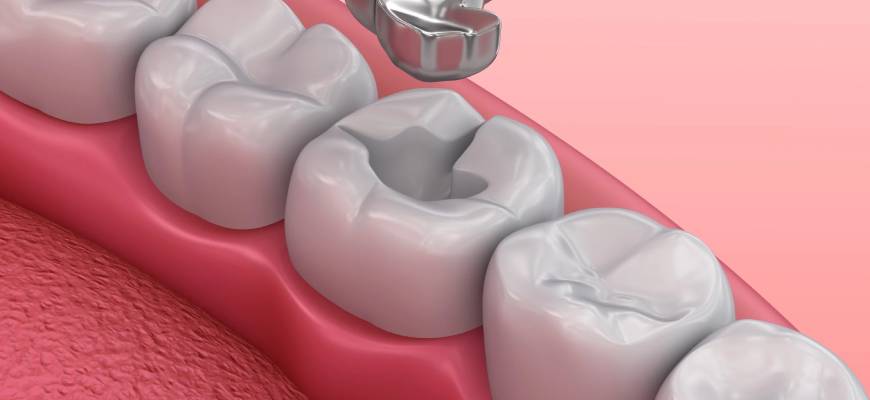 Amalgam Dolgu Değişimi