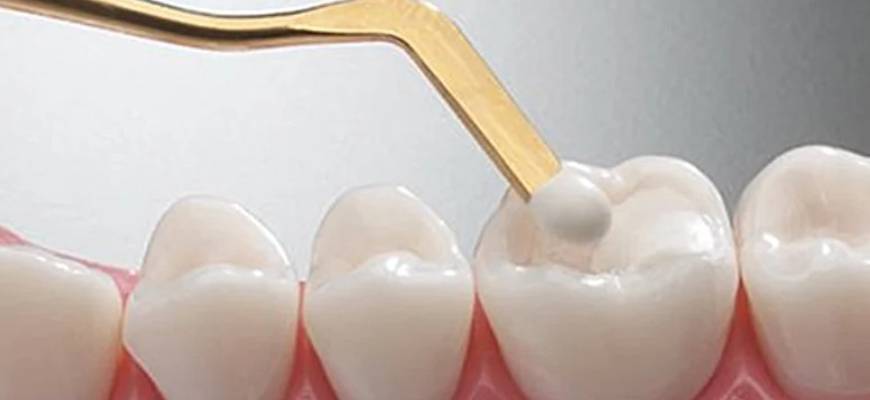 Beyaz Diş Dolgusu