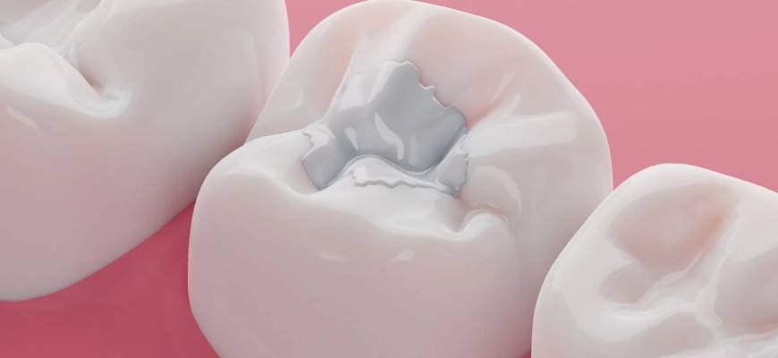 Civasız Diş Dolgusu