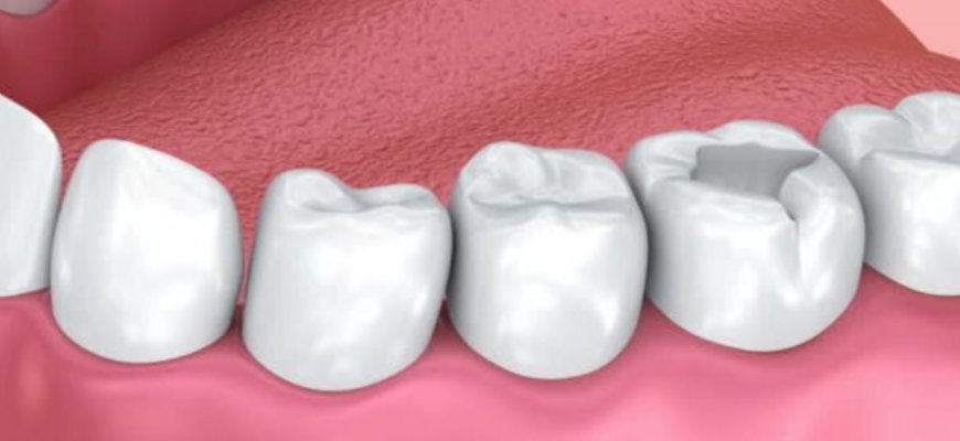 Kanal Tedavisi Sonrası Geçici Dolgu Düşerse Ne Yapılmalı?