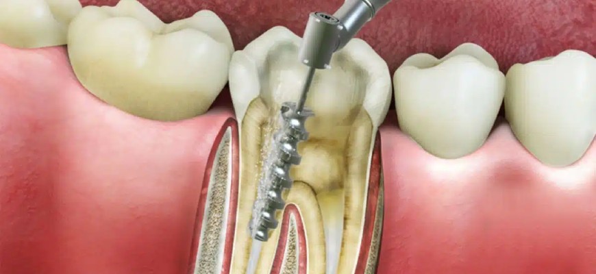 Kanal Tedavisi Yapılan Dişe Kaplama (Kuron) Ne Zaman Gerekir?