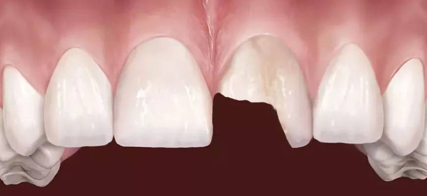 Kırık Diş Onarımı