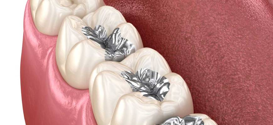 Metal Dolgu Değişimi