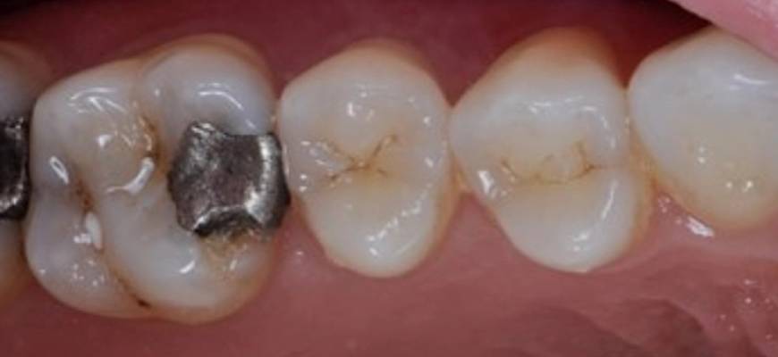 Siyah Dolgu Değişimi